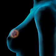 3-D Mammography for breast cancer detection