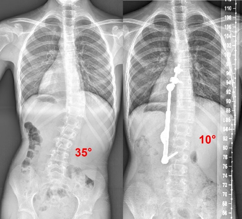 Innovative scoliosis surgery presents a conundrum for patients