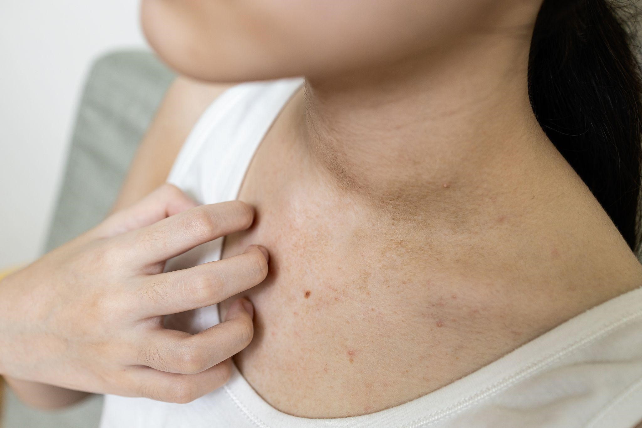 Manage Eczema and Topical Steroid Withdrawal with TCM